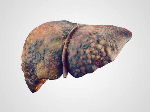 Hígado con hepatitis C crónica que ha derivado en una cirrosis
