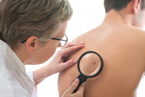 melanoma y lunares