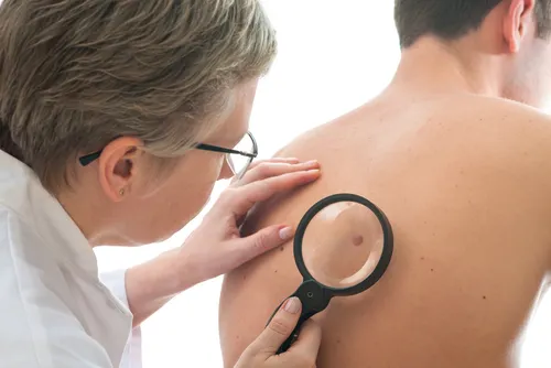 melanoma y lunares
