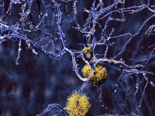 Acúmulos externos de beta amiloide en el alzheimer