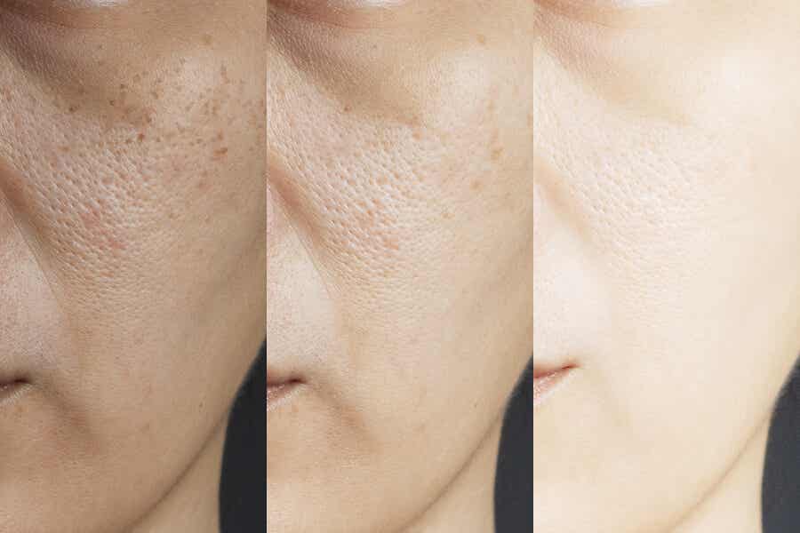 8 remedios caseros para los poros dilatados