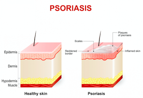 Factores que afectan tu psoriasis
