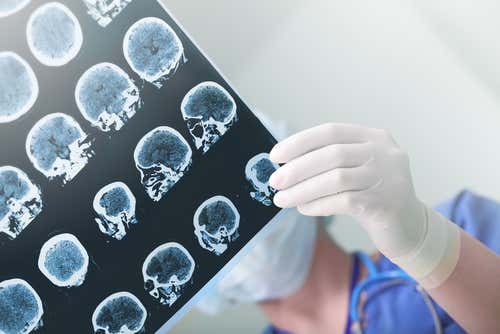 RMN del cerebro para el diagnóstico de la epilepsia