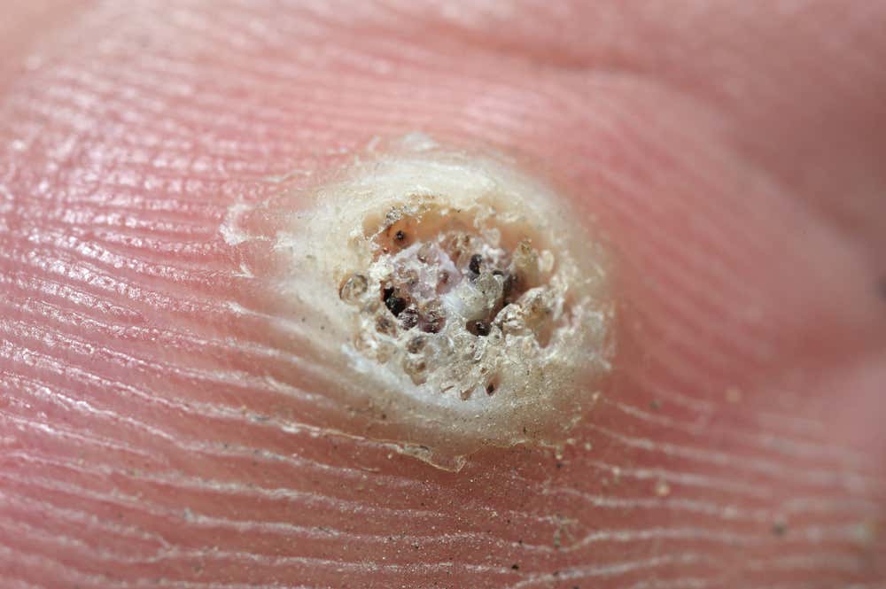 Verruga provocada por el virus del papiloma humano
