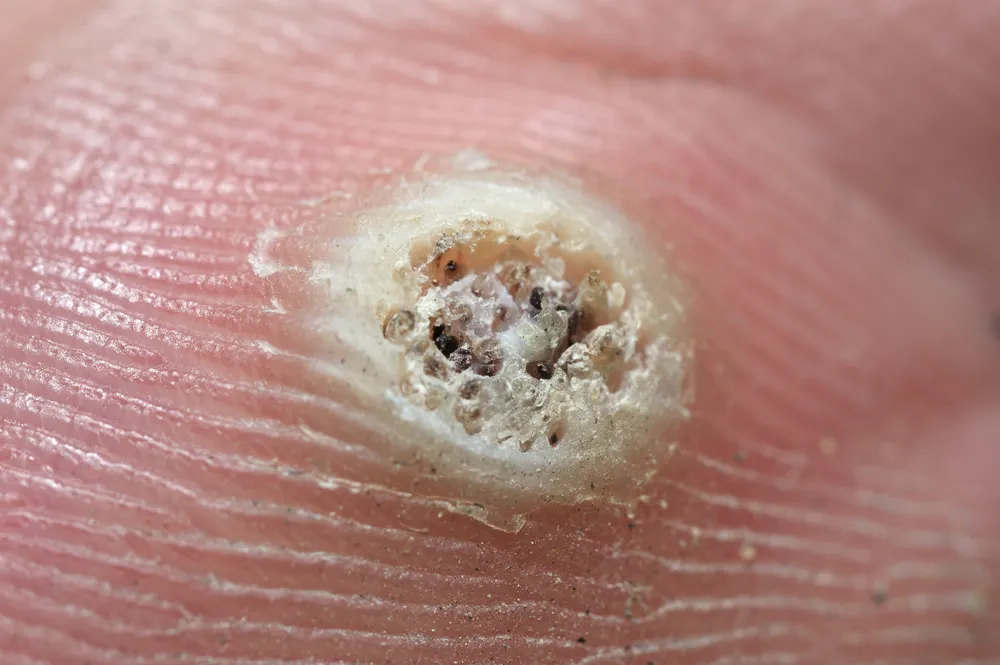 Verruga provocada por el virus del papiloma humano