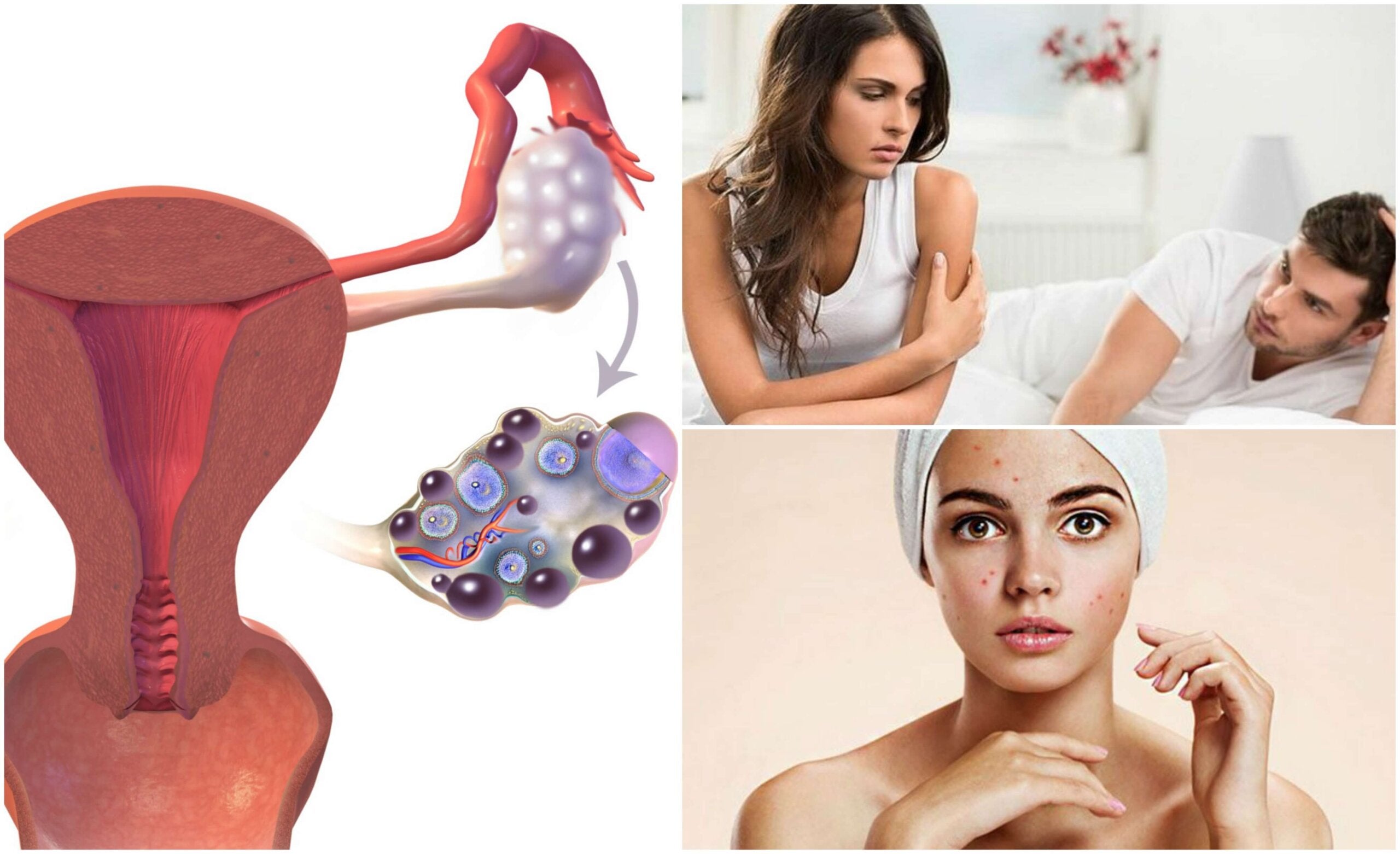 7 Síntomas De Síndrome De Ovario Poliquístico Que No Debes Pasar Por Alto Mejor Con Salud 5895