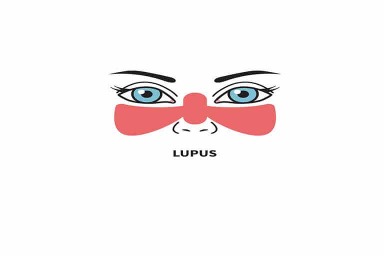 Tratamiento del Lupus Eritematoso Sistémico (LES)
