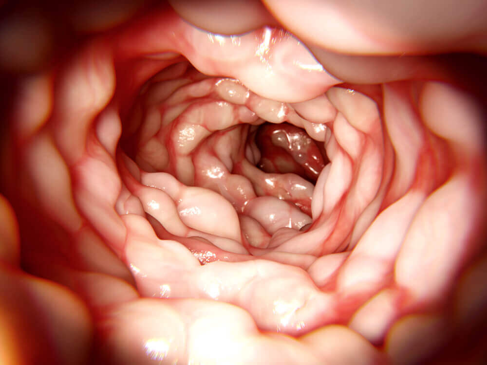 Perforation gastro-intestinale.