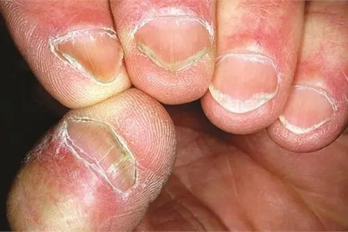 uñas con Coiloniquia