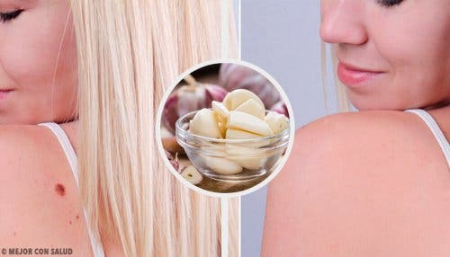 9 formas de quitar verrugas rápidamente