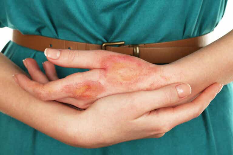 Quemaduras en los dedos: 6 remedios caseros para aliviarlas
