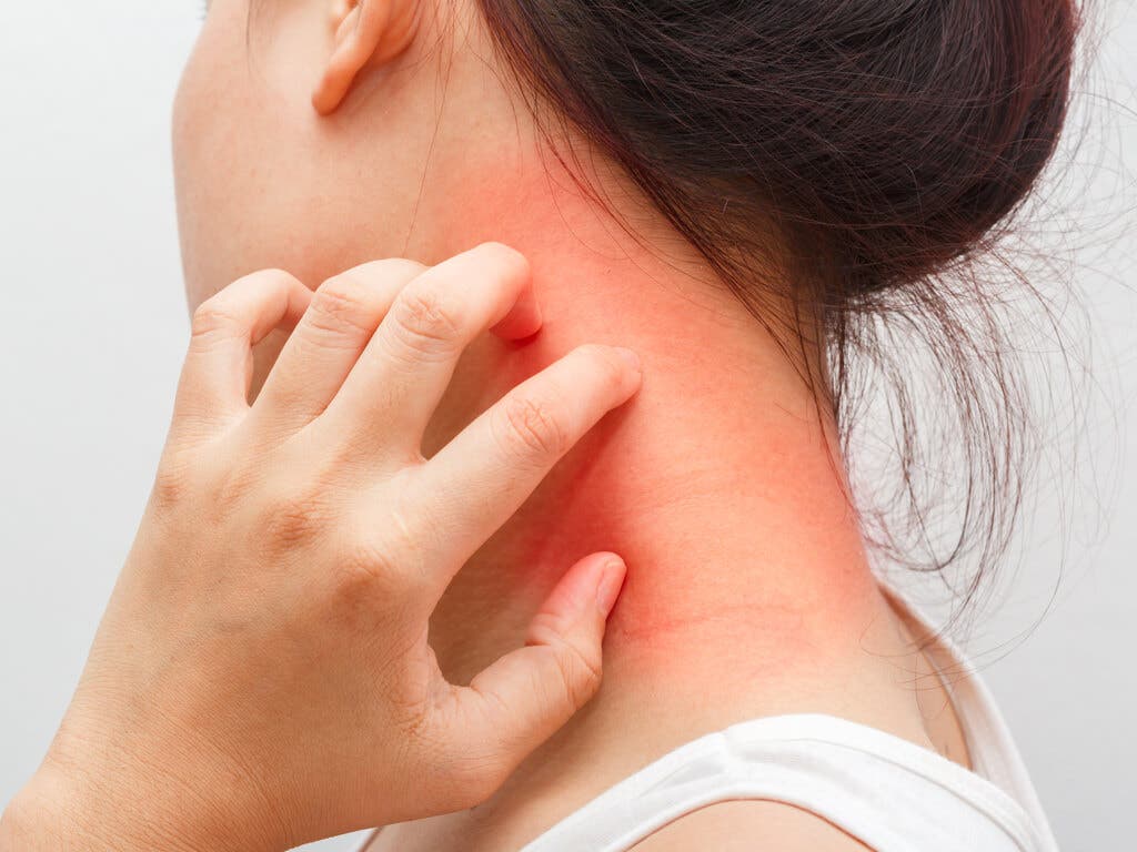 Mujer con dermatitis atópica