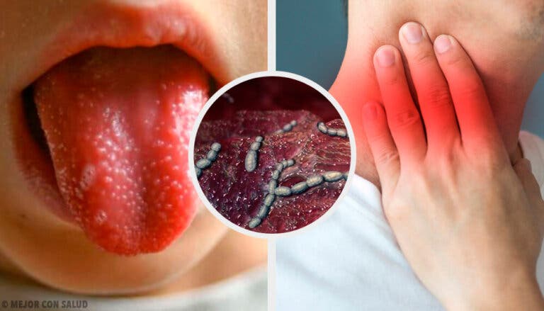 Escarlatina o fiebre escarlata