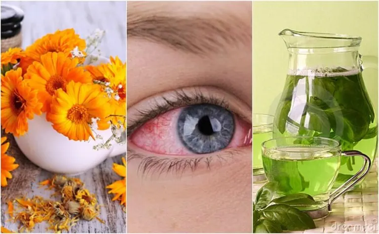Los 5 mejores remedios para calmar la conjuntivitis naturalmente