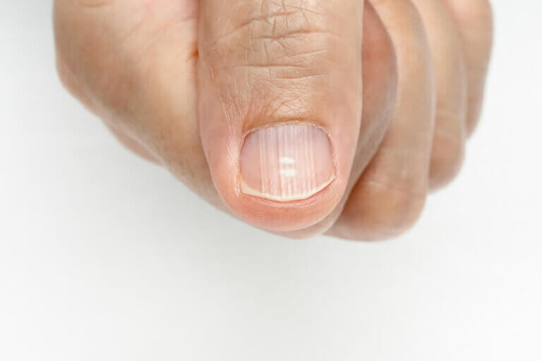 Correctamente Pase para saber Superposición Por qué me salen líneas en las uñas y cómo eliminarlas? - Mejor con Salud