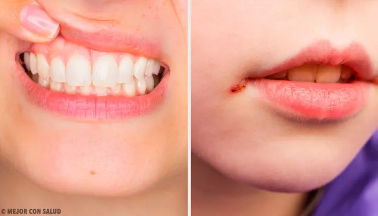 ¿Por qué se ponen las encías blancas?