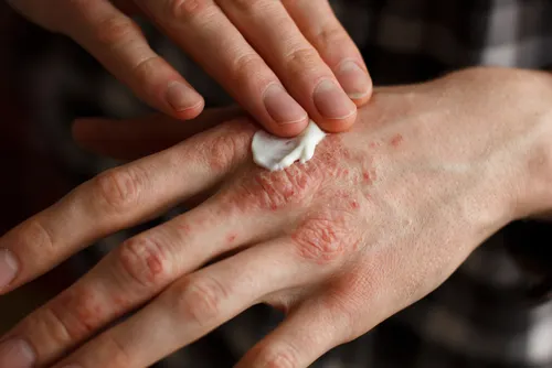 Hombre aplicándose crema en la mano