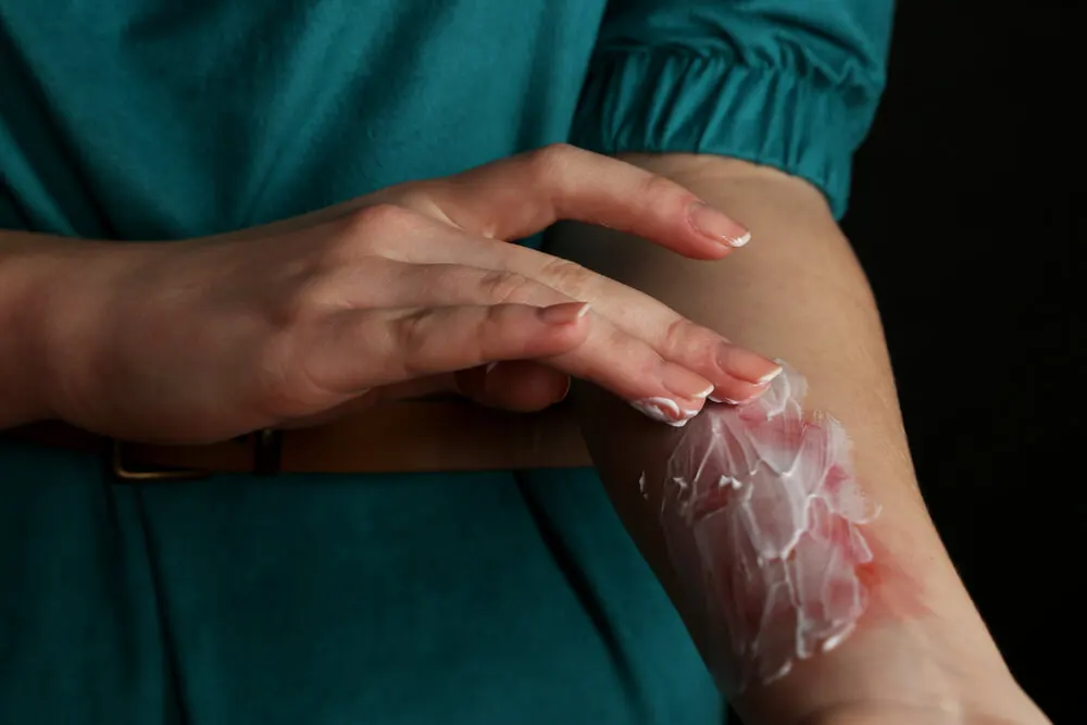 Si una persona se ha prendido fuego