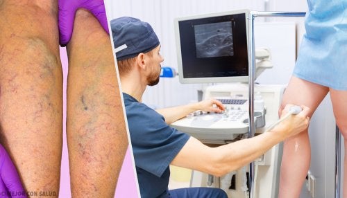 Tratamiento tópico y oral para prevenir y tratar las varices