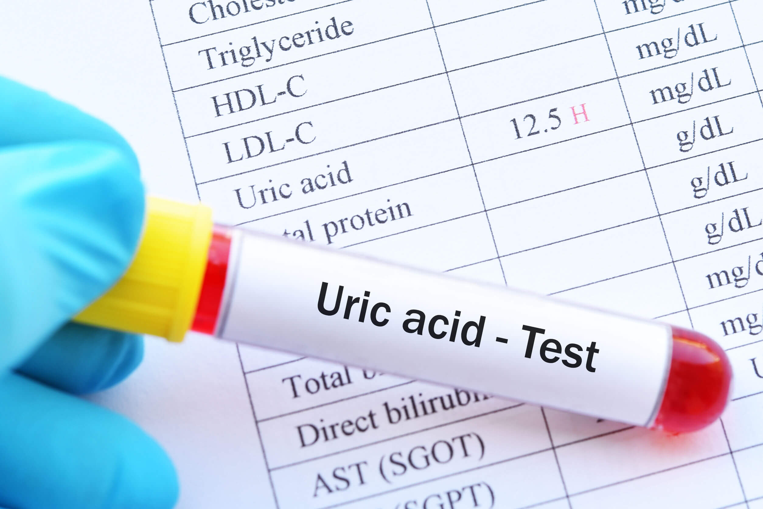 Тест на мочевую кислоту. Acid Test. Uric acid normal.