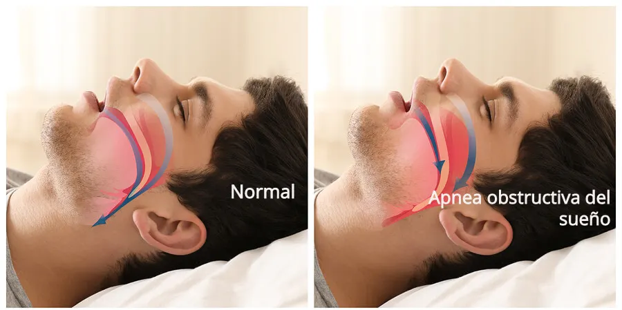 La apnea obstructiva del sueño