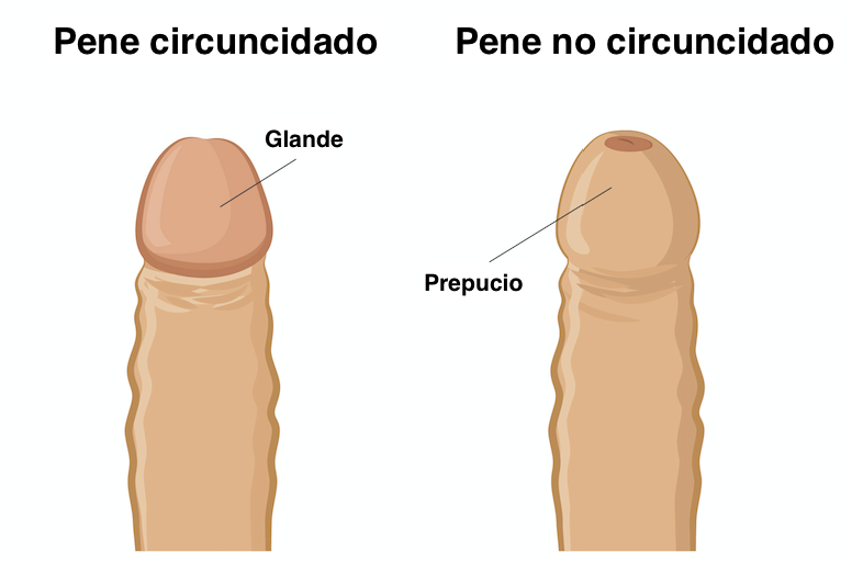La fimosis ocurre en penes no circuncidados.