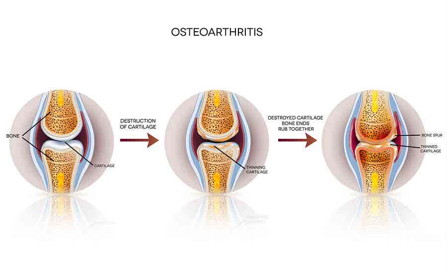 Etapas de la osteoartritis.