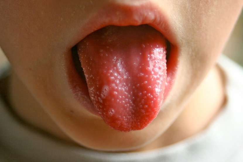 fiebre-escarlata-lengua