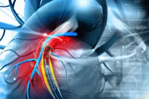 Las placas de ateromas aumentan los riesgos de ataques al corazón