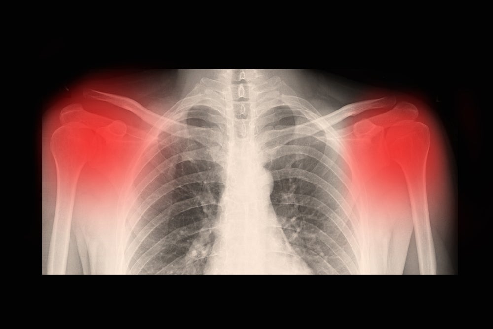 Imagen de rayos x que muestra inflamación en la articulación de la clavícula