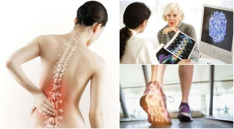 6 cosas sobre la osteoporosis que debes conocer