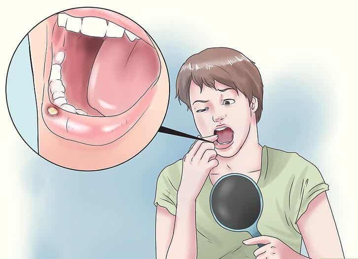 8 remedios naturales para las úlceras en la boca