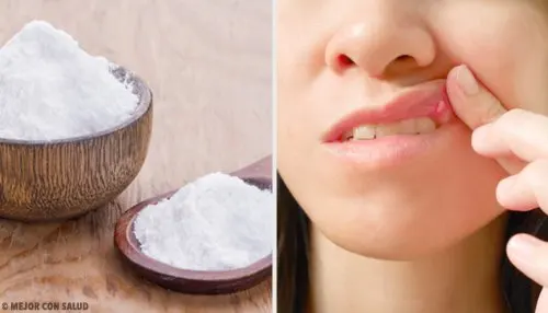 remedios naturales para las llagas