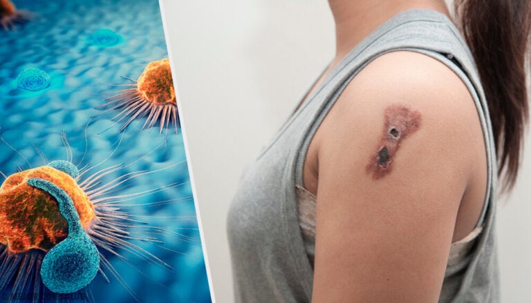 Cáncer de piel: todo lo que debes saber