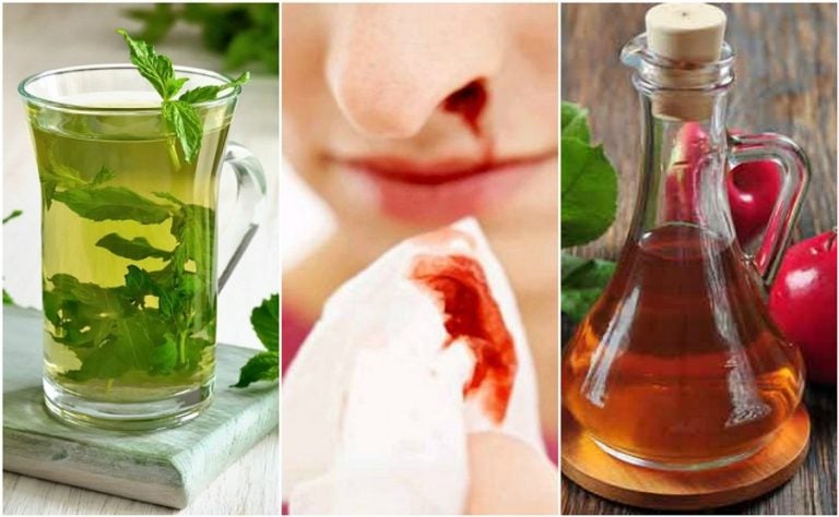 Cómo detener el sangrado nasal con 6 remedios naturales