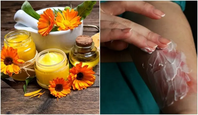 Cómo preparar una crema de aloe vera y caléndula para calmar las quemaduras