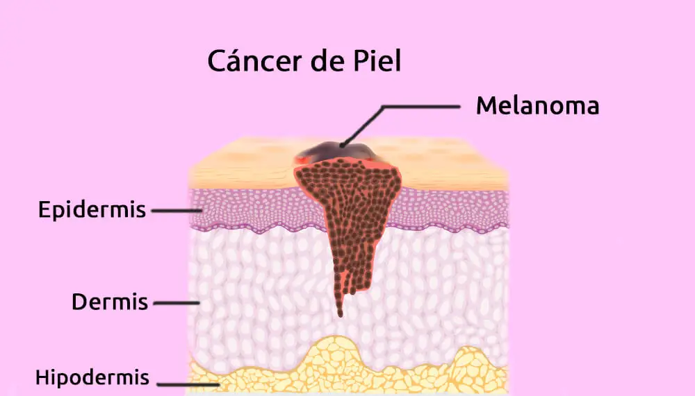 El melanoma