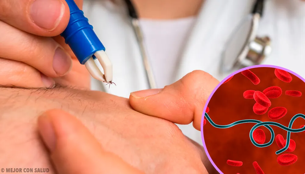 Enfermedad de Lyme por garrapatas