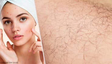 Hirsutismo: qué es, causas y remedios naturales para tratarlo
