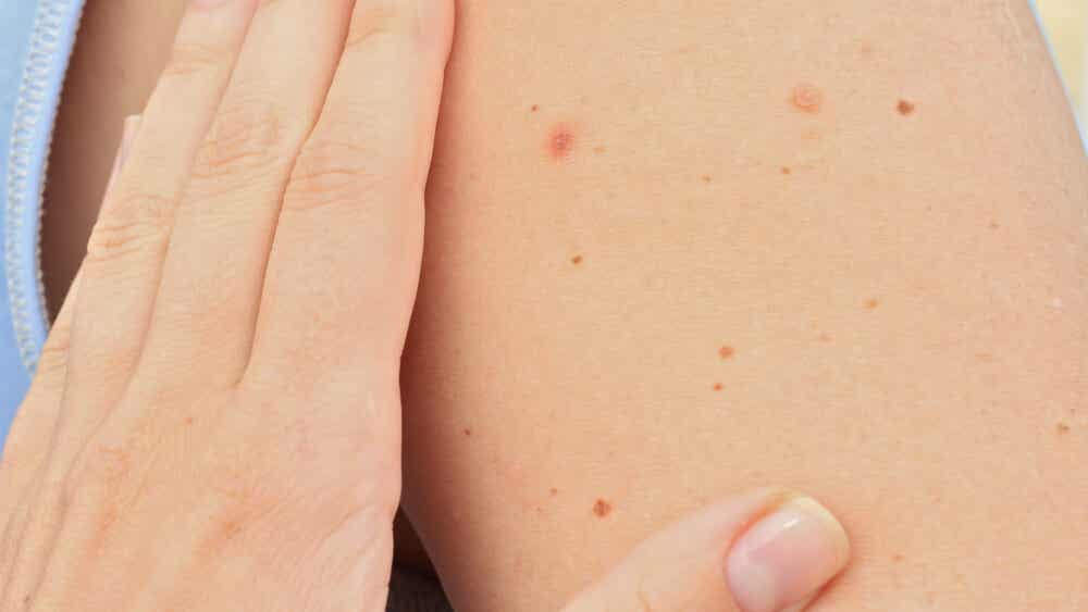 Señales que indican que necesitas eliminar tu lunar lo antes posible Mejor con Salud Señales que indican que necesitas eliminar tu lunar lo antes posible Mejor con Salud
