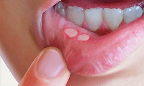 7 de curar llagas en la boca con remedios caseros