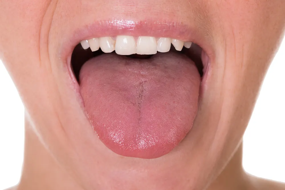 La lengua geográfica es normal.