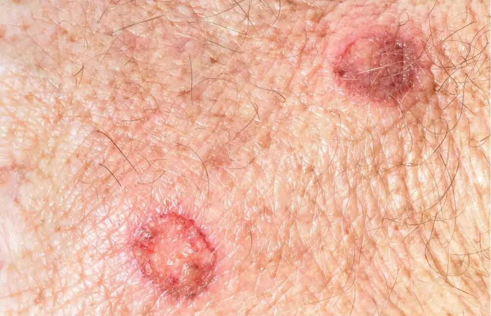 Los lunares y el melanoma