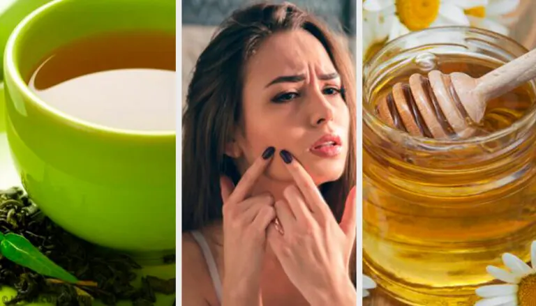 9 remedios naturales efectivos contra el acné juvenil