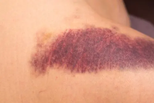 Síndrome purpúrico