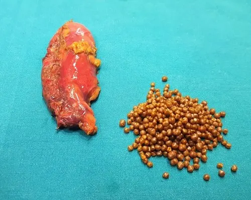 Tipos de cálculos biliares