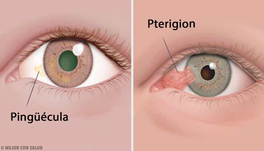 Tumores de córnea: pinguécula y pterigion