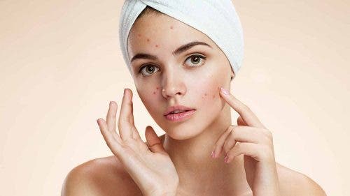 Chica-con-acne-por-hirtusismo