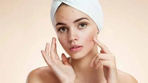 Chica-con-acne-por-hirtusismo