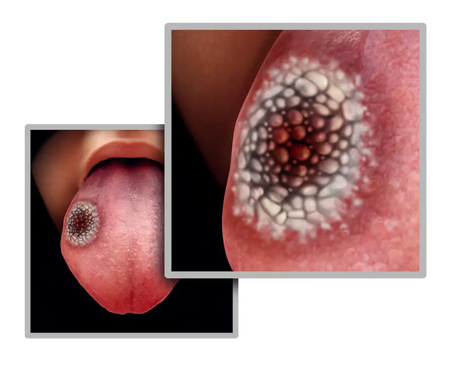 Cáncer de lengua.